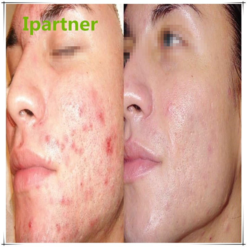 Vente chaude Derma Roller pour les soins de la peau