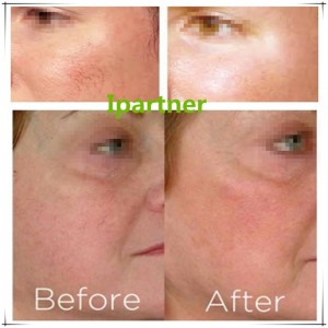 Le laser à diode Ipartner LS980 soulage le système de rougeur